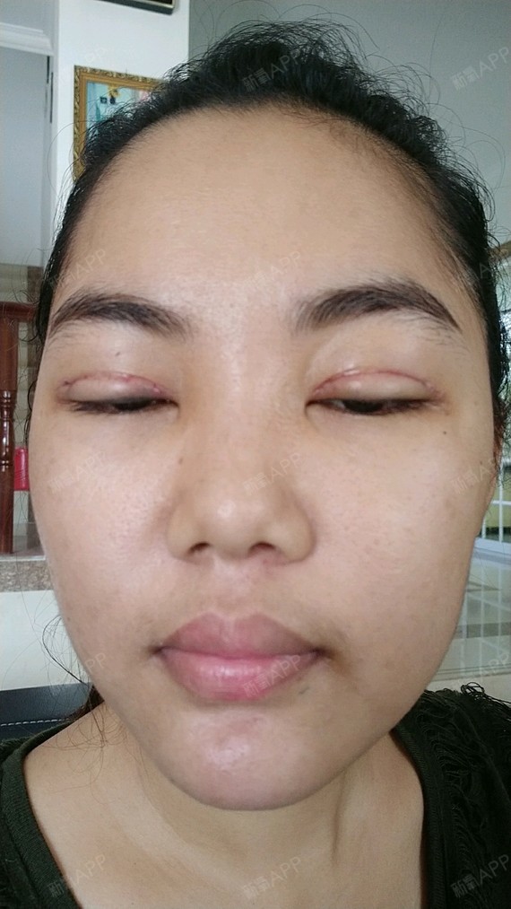 上眼睑去脂好不好_效果图_麦子的春天714上眼睑去脂术后第7天_新氧