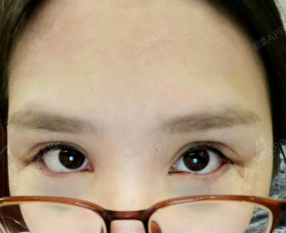 武汉开外眼角好不好_效果图_鲲uuu开外眼角术后第天_新氧美容整形