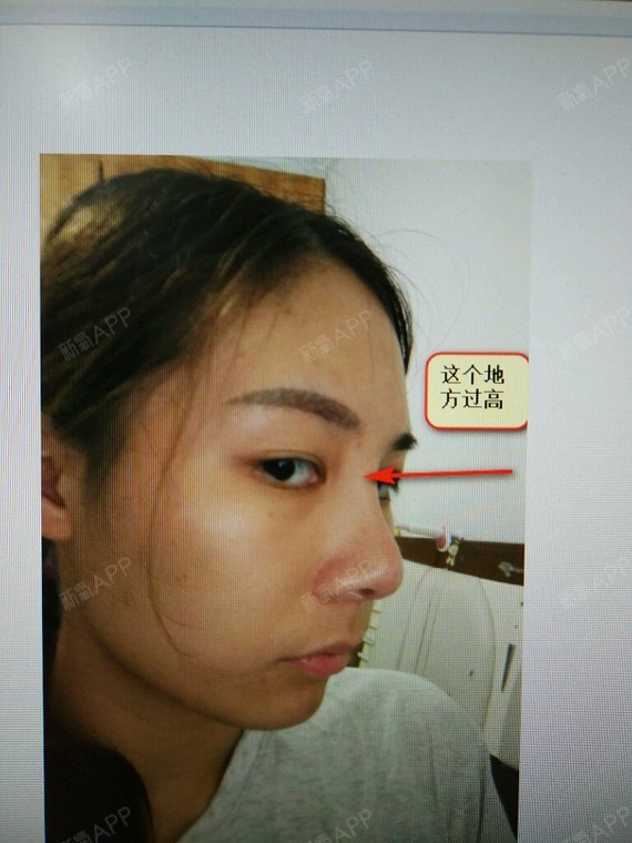 现在看起来山根很高而且拉扯眼角了,请问医生可以自行_圈子-新氧美容