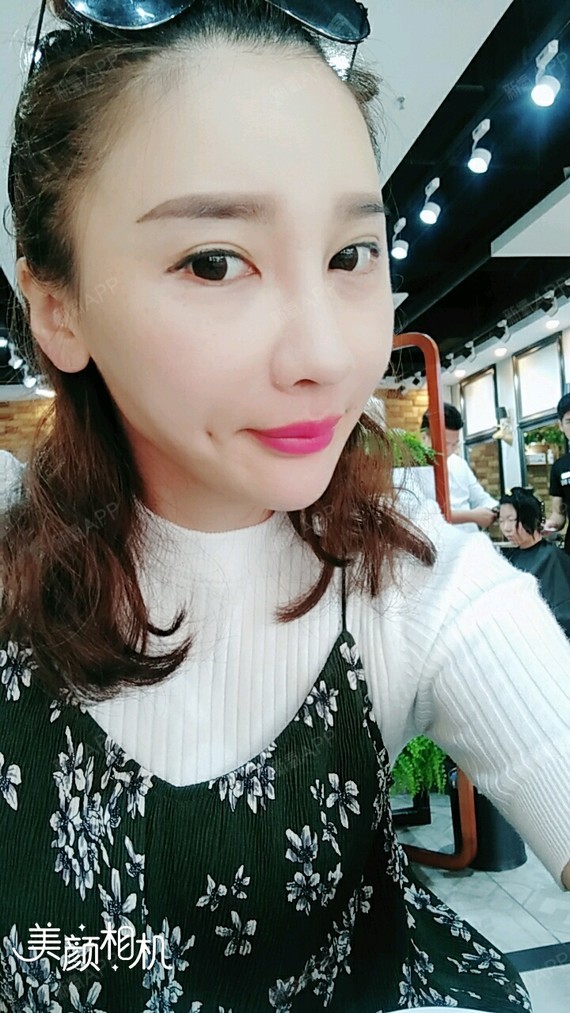 术后第16天