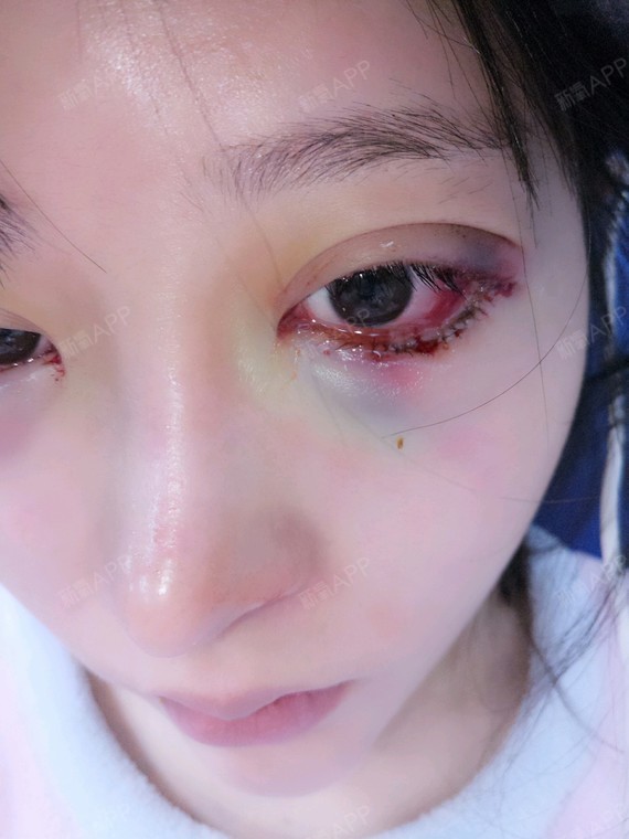 外眼角下至充血有严重血泡需要怎么恢复才快一点 差不多多久