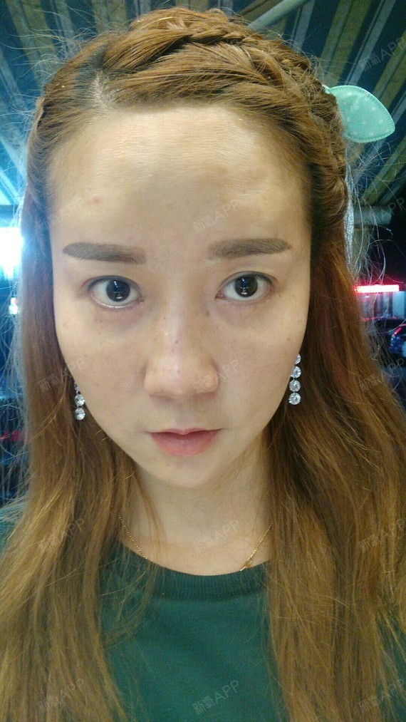 丰眉毛上面凹陷