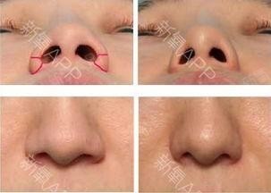 有顾客私信问自己鼻翼大怎么解决?