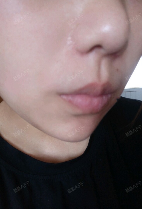 iyufei手术缩鼻翼第114天美丽日记