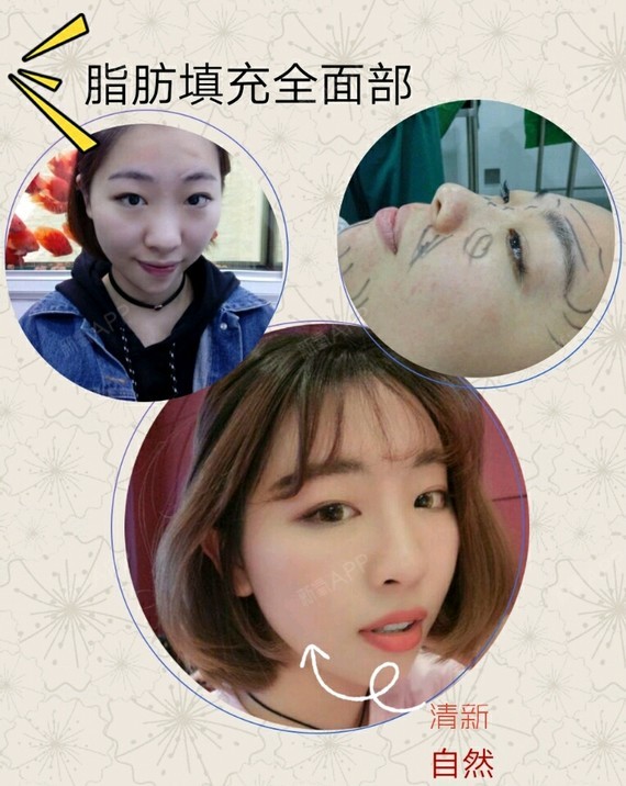 为什么做完自体脂肪填充后皮肤会变好呢?