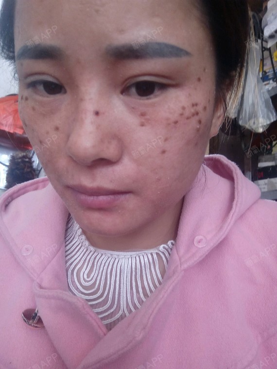 10:20号今天是做面部排毒祛斑期第十一天,期待快快修复