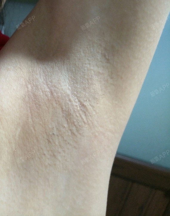 氧气1851751505920568 | 激光脱毛 | 术后当自强 | 肇庆同城 | 脱腋毛