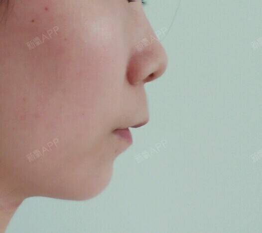 上嘴唇可以几乎没有人中过长而且还凸起能解决吗