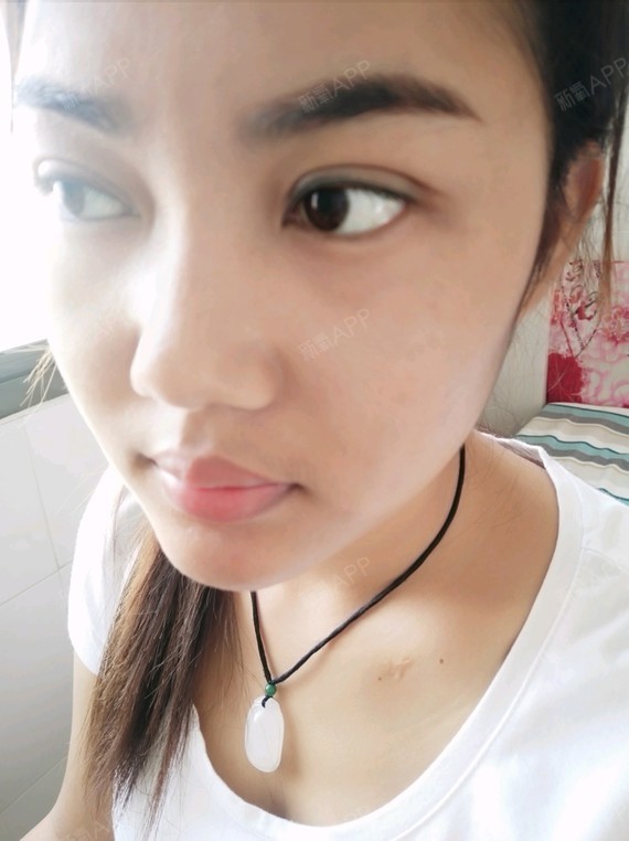 昆明上眼睑去脂好不好_效果图_麦子的春天714上眼睑去脂术后第44天