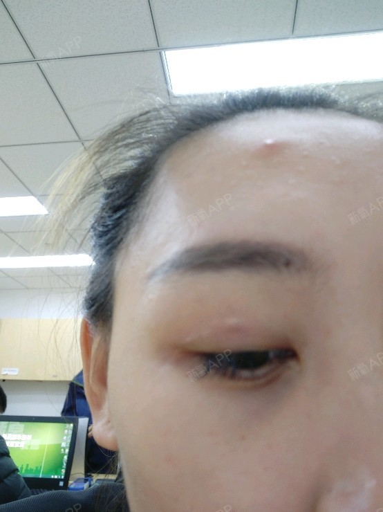 一年多的时间,当时做完之后眼皮上就有个线头鼓起来了_圈子-新氧美容