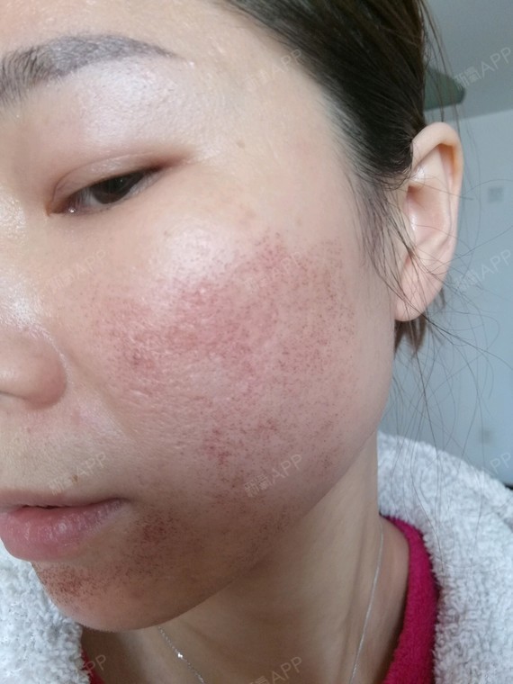 氧气2546391509939218点阵激光第2天美丽日记