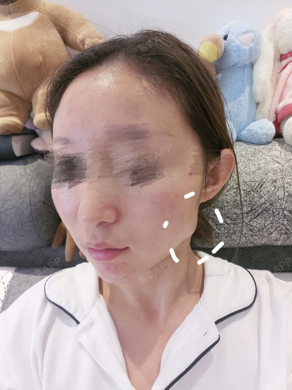 瘦脸针失败,两年了,面颊凹陷苹果肌下垂,同样情况的_圈子-新氧美容