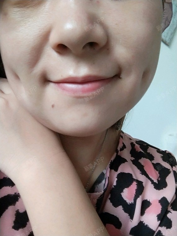 joannn酒窝成形术第1天美丽日记