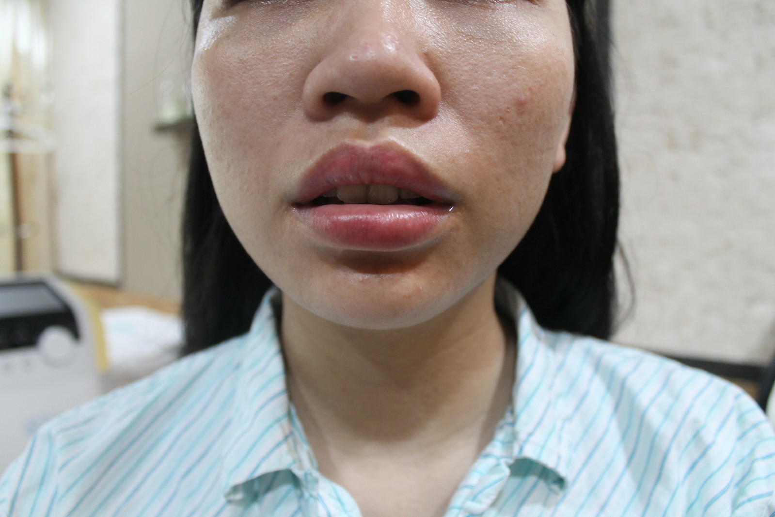 唇の印象を変える 新しいヒアルロン酸〜ジュビダームビスタ®︎ボルベラ XC治療開始 | 医療法人涼葵会 WCLINIC 足立真由美のブログ