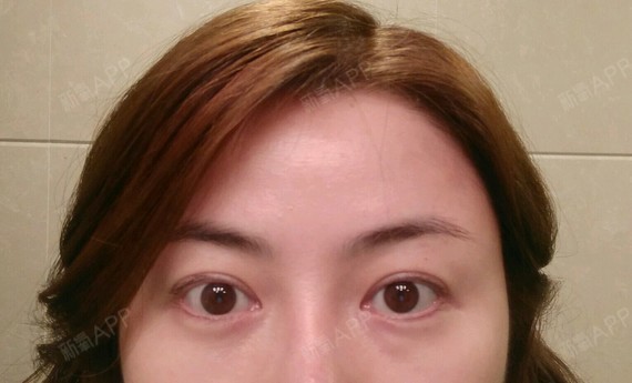 术后38天,右眼眼袋位置的硬块仍然存在,非常显眼,_圈子-新氧美容整形