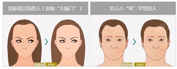 那麼男性發際線可以調整嗎?