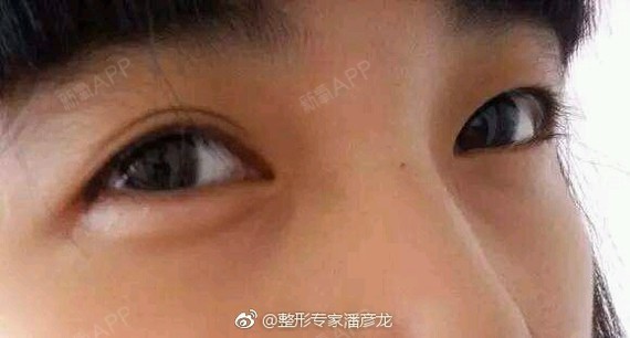 大小眼 又称 雌雄眼 是由于一只眼睛单眼皮而另 圈子 新氧美容整形