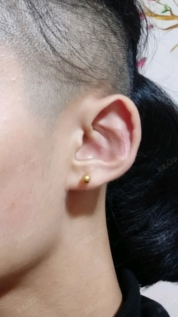 耳朵取了耳软骨后严重变形,有什么方法修复,或者填充_圈子-新氧美容