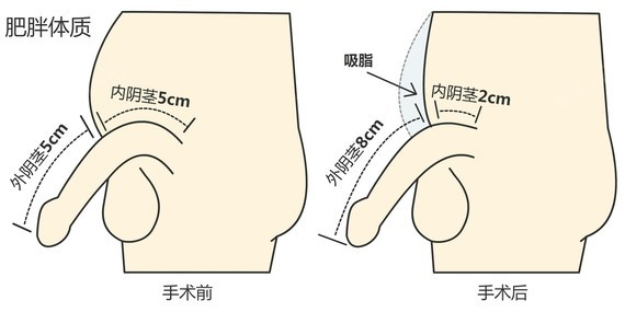 肥胖人群丁丁延长更多?不懂看图?,12月9-10日_圈子-新氧美容整形