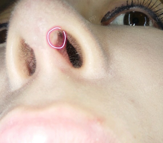 快两个月了,鼻子里面伤口最近偶尔有点血渍鼻孔内侧切_圈子-新氧美容