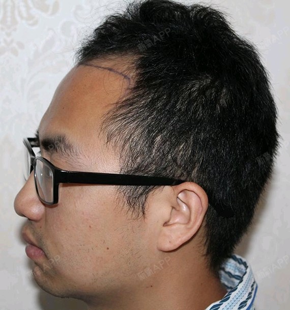 氧气w0d0afd种植发际线第0天美丽日记