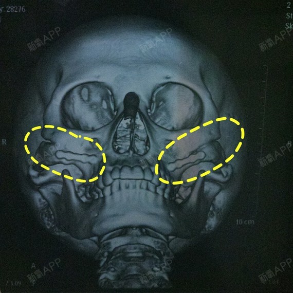 颧骨已愈合,木有下滑,钉的非常结实.