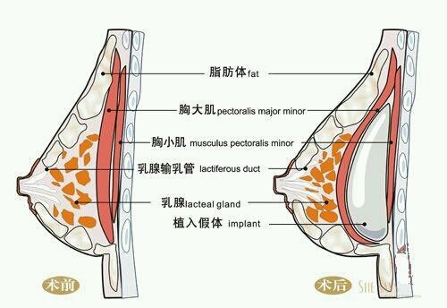 先天性乳腺发育不全,成小乳畸形及单纯为美容目的要求做隆胸手术的.