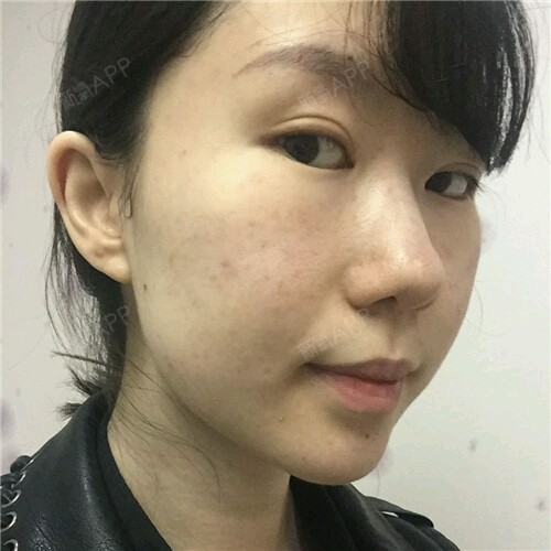今天做了溶脂针的术后第一天,早上起来不肿,针眼消下_圈子-新氧美容