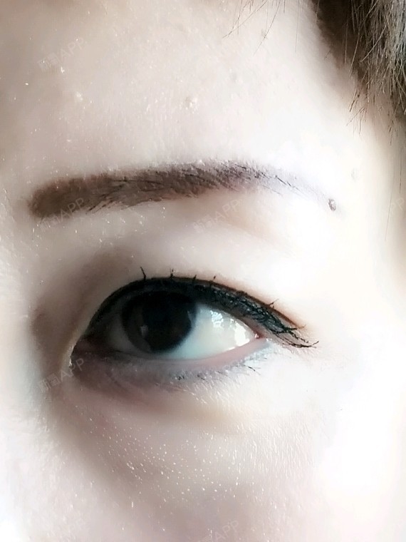 天生小/内眼角开太大/有肉条这样的眼睛还有救吗?