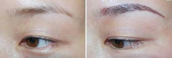 【福州比华利】哪些切口是提眉术常用的?