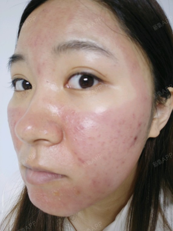 同事都以为我吃什么过敏了