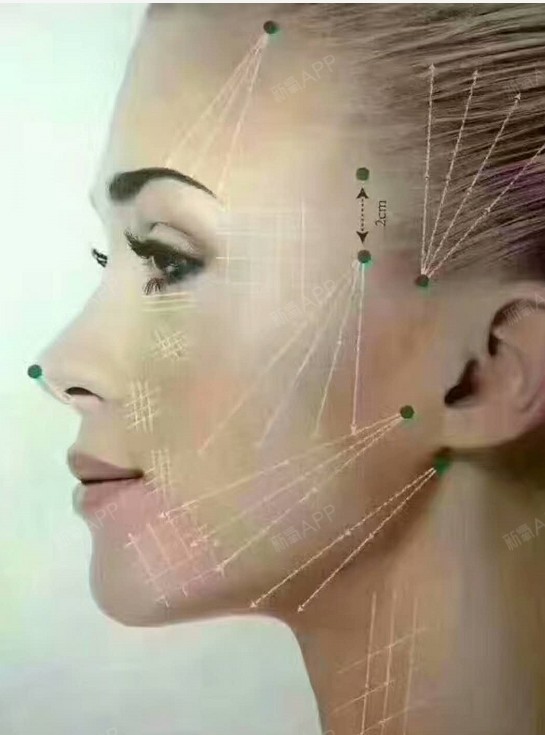 项目介绍:3d无痕线雕提升技术