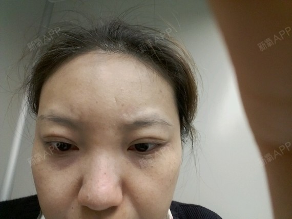 请问医生眼角上翘,看起来凶,和男的眼睛一样,有什么办法?