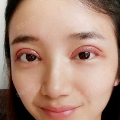 眼部修复好不好_效果图_嘉茵_眼部修复术后第0天_新氧美容整形