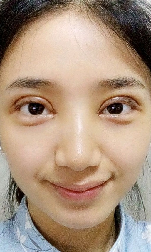 眼部修复怎么样_恢复过程_效果如何_嘉茵_整形日记1.8_新氧美容整形