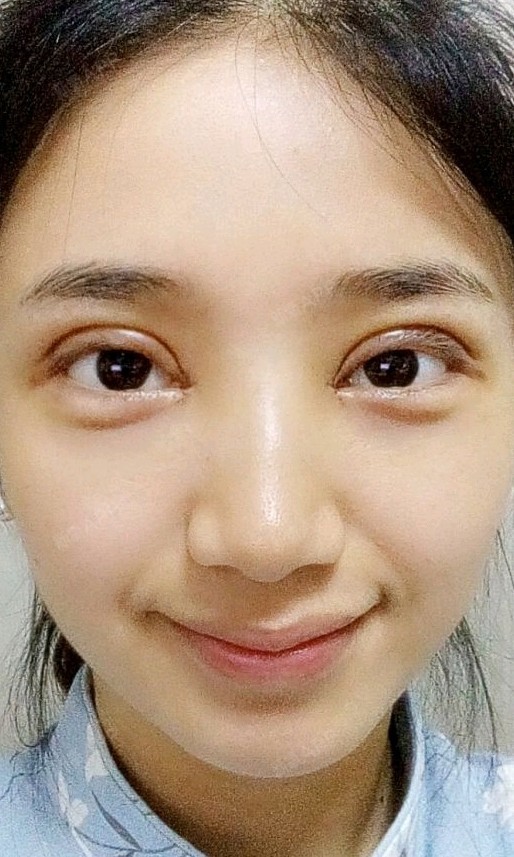 眼部修复好不好_效果图_嘉茵_眼部修复术后第0天_新氧美容整形