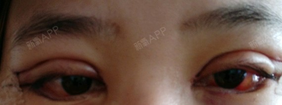 眼睛感觉有一点点消肿   但是变化不大问了医生说是结膜水肿  需要