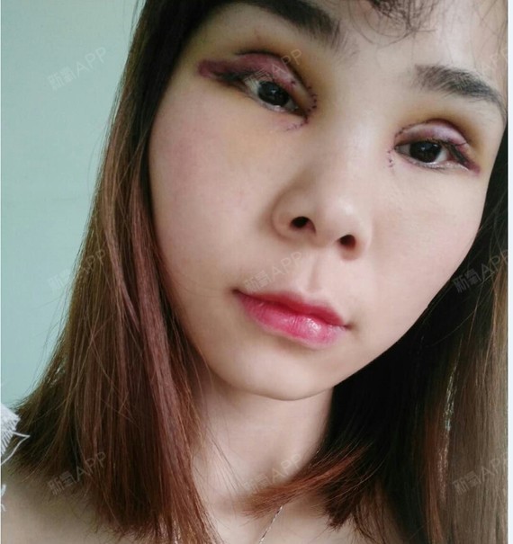 全切双眼皮开眼角1天了