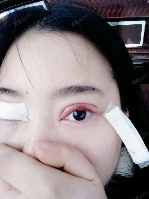 咳咳,第一天,感觉有点肿,没事儿,为了美丽嘛,和双眼皮一起,开始减肥