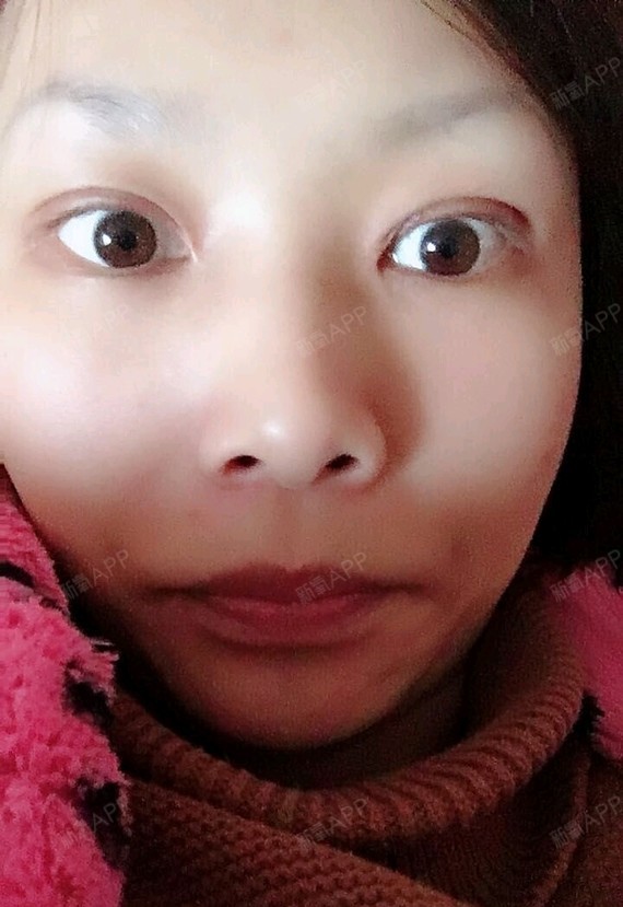 又自然了不少,像天生的,好多人都看不出来是割的双眼皮呢