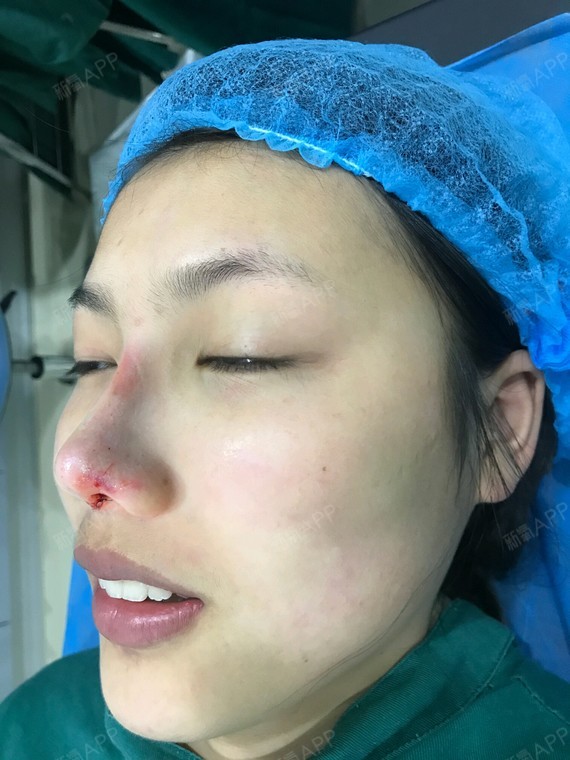 伊琳异体半肋软骨鼻部多项术后第0天