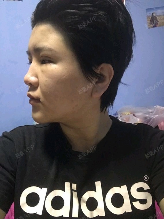 视觉酱自体脂肪全脸填充第15天美丽日记