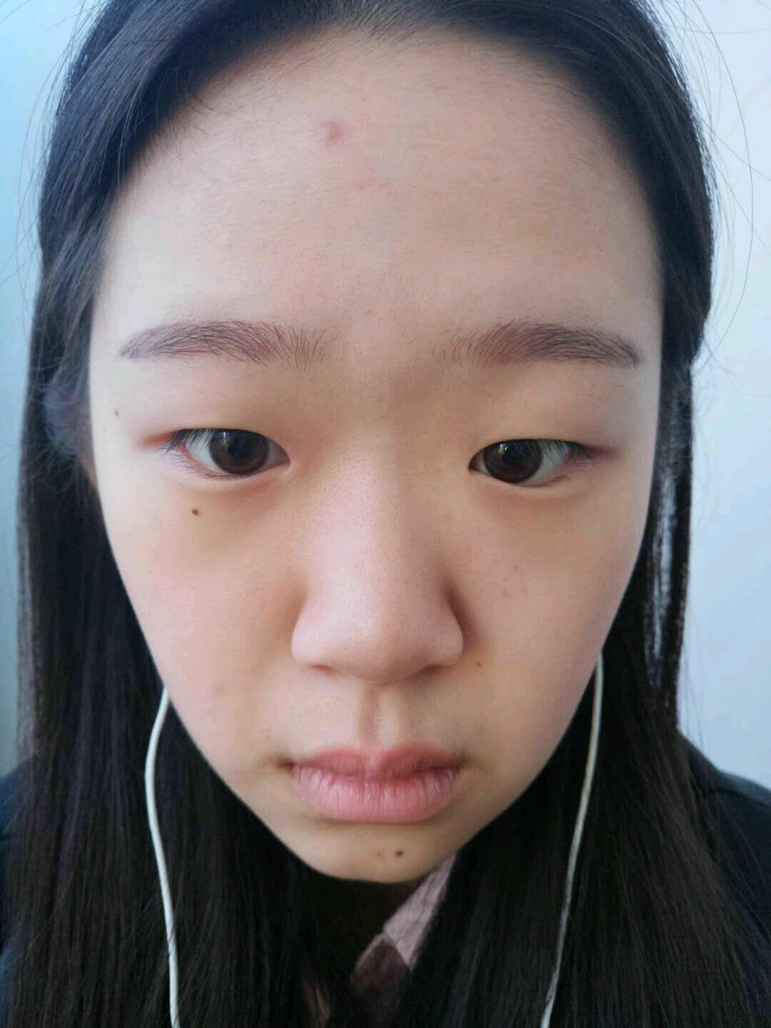 我眼角包太厉害了还是会有疤 会坚持擦药