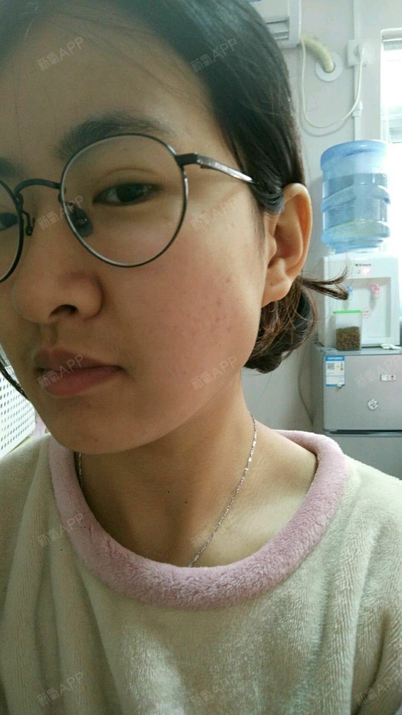 今天是打瘦脸针的第五天,已经不肿了,咬紧牙发现有会_圈子-新氧美容
