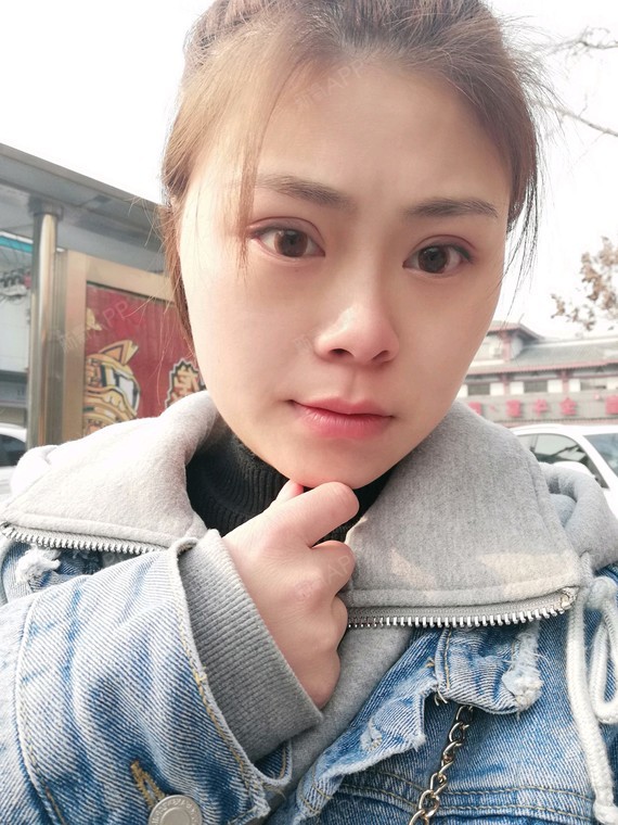 半个多月了 咬肌小了 脸部也没有什么不适