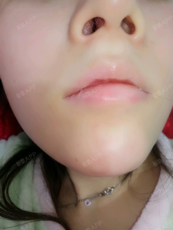 有一侧鼻孔好像增生了摸着感觉硬硬术后不到一个月?