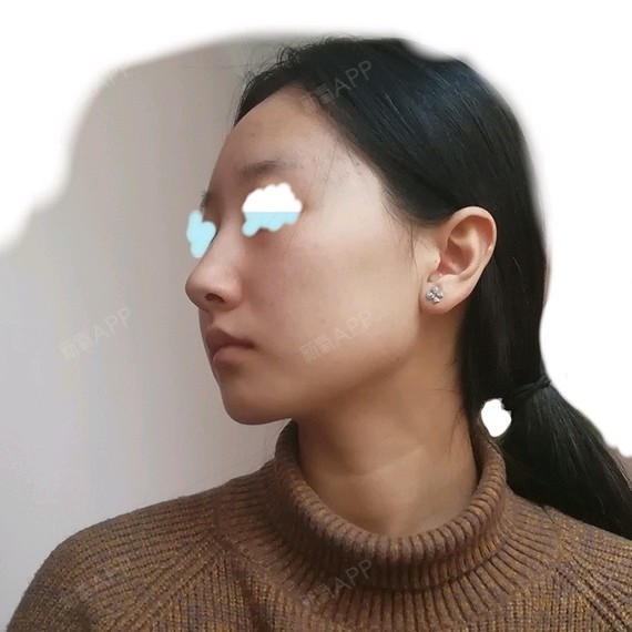 鼻子很长,感觉很奇怪.有什么手术能缩短一下中庭长度吗?