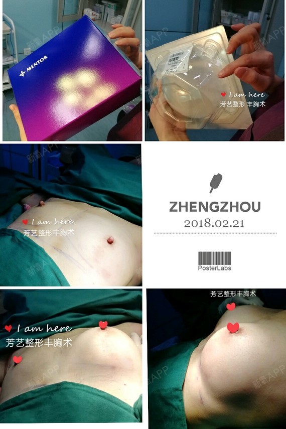 缩胸手术图片效果图图片