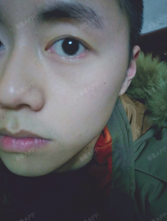 眼皮上一直有一个小疙瘩