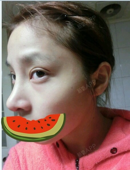 鼻头缩小(narrowingofnose)即缩小鼻_圈子-新氧美容整形